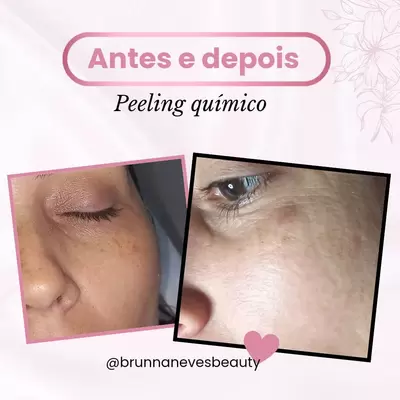 Peeling químico