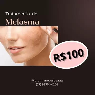 Tratamento melasma